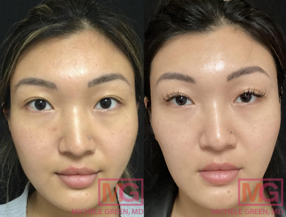 Facial Slimming Injections & Treatments