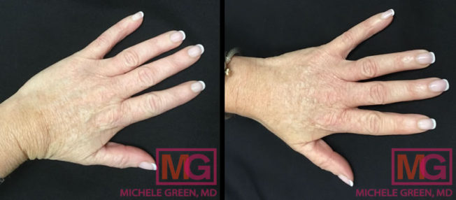 Hand Rejuvenation NYC, Laser Hand Rejuvenation Treatments