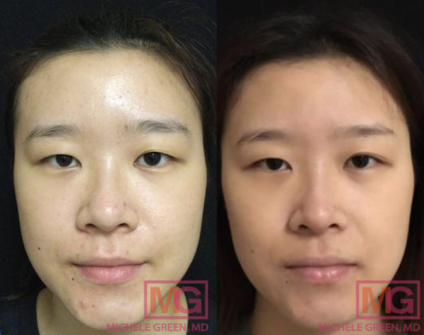 Acne Scar & Acne Treatment for Asian Skin - Dr. Michele Green M.D.