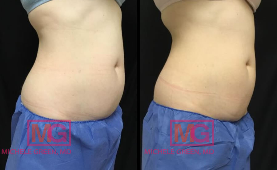 How CoolSculpting Significantly Reduced One Woman's Midsection After Just  One Treatment - NewBeauty
