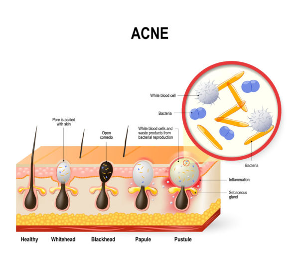 Does Sweat Cause Acne? Summer Acne & How to Prevent Sweat Pimples