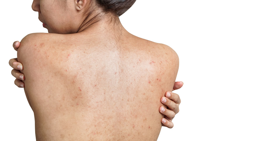 Back & Chest Acne  Causes, Tips & How To Get Rid of Back Acne