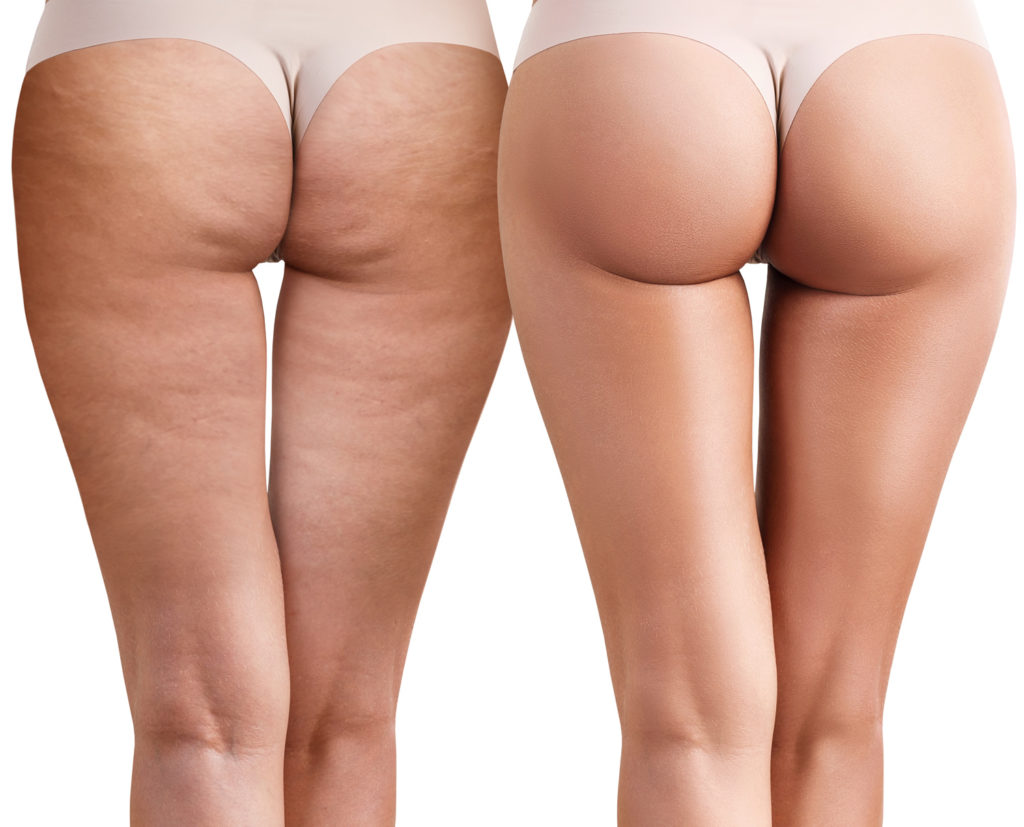 Cellulite Treatment for Legs in New York - Dr. Michele Green M.D.