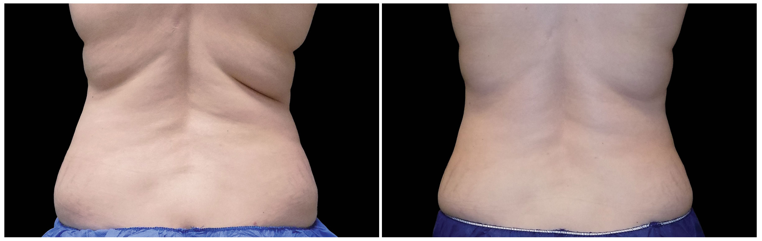 CoolSculpting for Back Fat - Dr. Michele Green M.D.