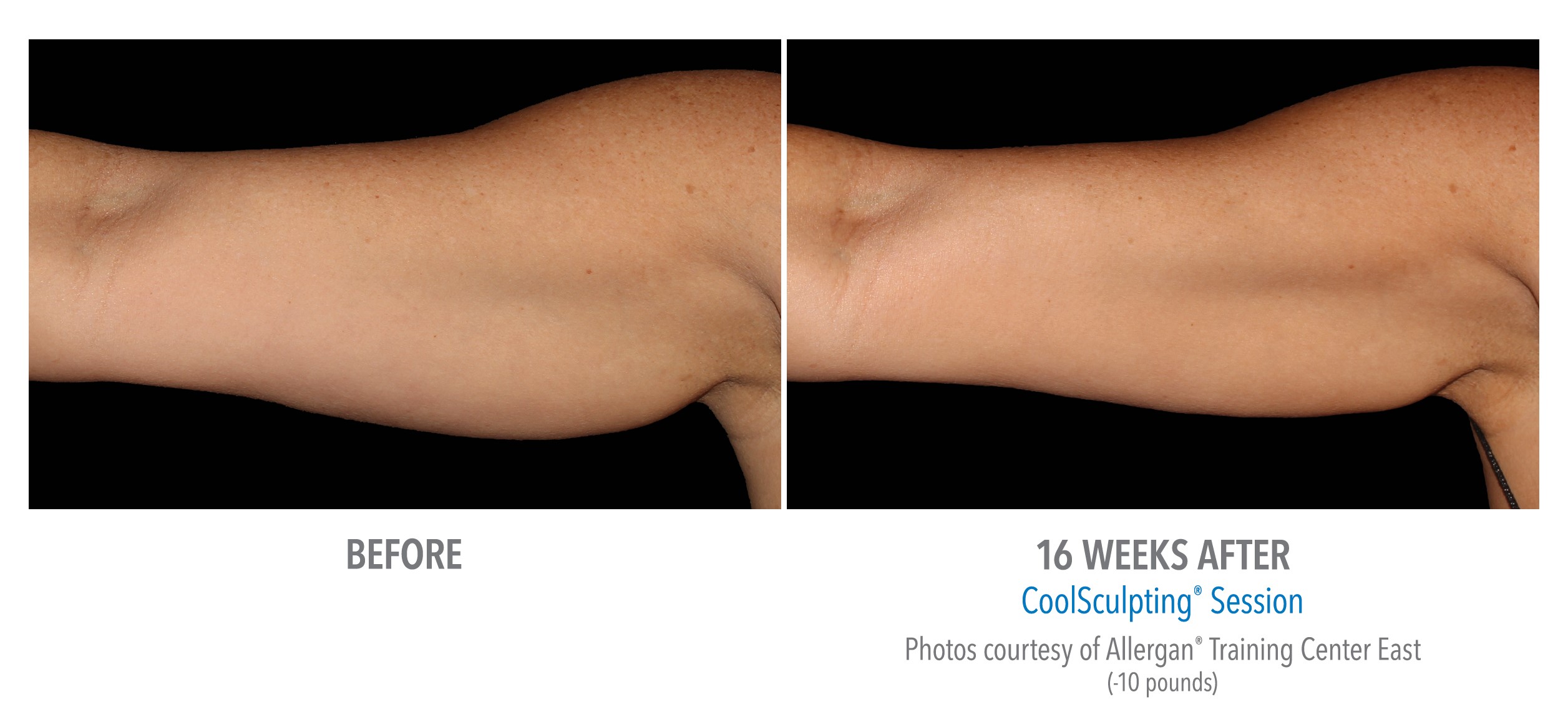 Banish Bra Bulge with Underarm Fat Removal - A New You Aesthetics