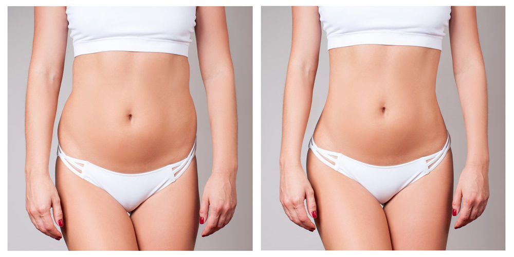 Laser Skin Tightening For Stomach, Thermage & CoolSculpting