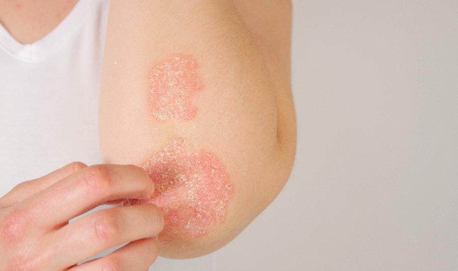 Allergy Rash 101, Understanding Skin Allergies