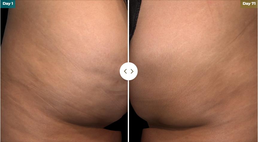 Hacks for Getting Rid of Cellulite: Smooth Body Contours: Aesthetic Medical  Spa