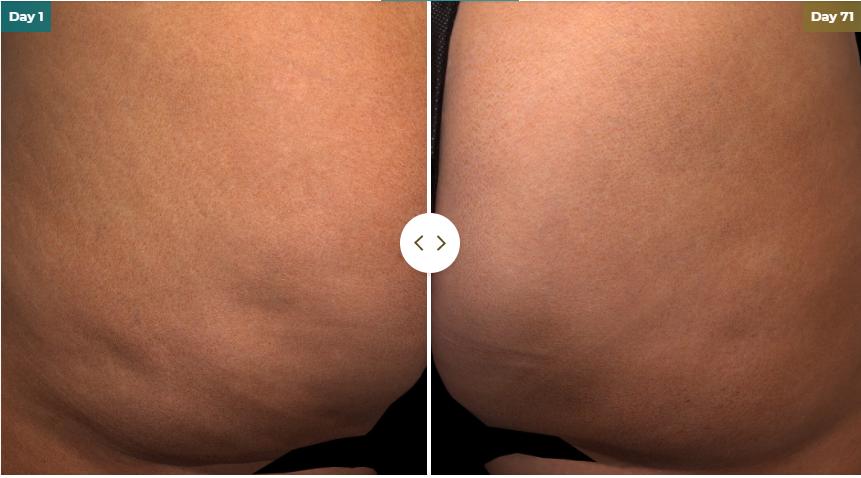 Cellulite removal - The Slimming Rooms