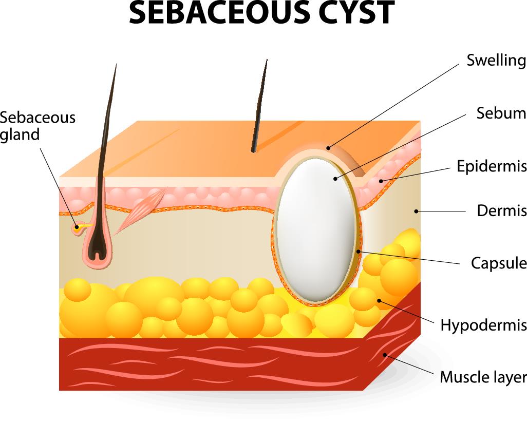 Sebaceous Cysts What Is A Sebaceous Cyst Dr Michele Green M D