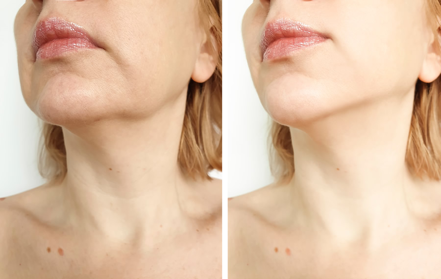 The Best Non-Surgical Treatment for Skin Tightening - Skin Tightening