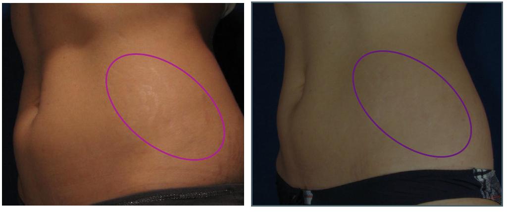 Stretch Marks Removal Toronto - Bellair Laser Clinic