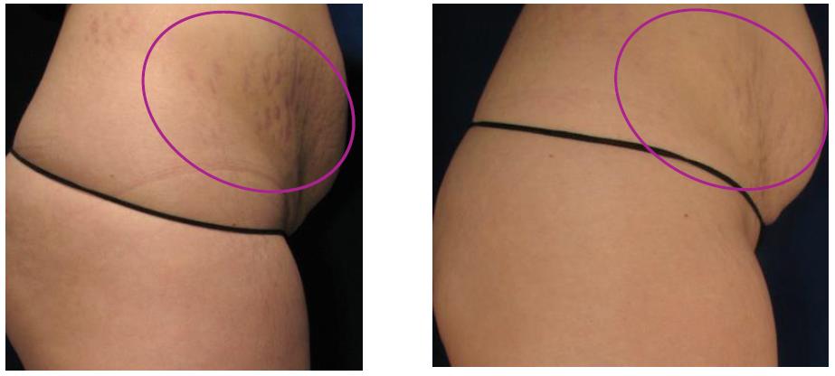 Removal of stretch marks